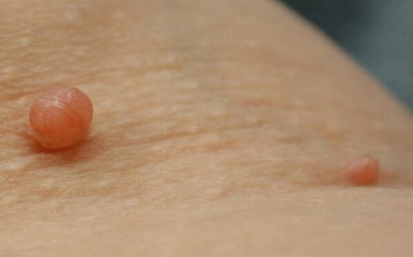 papilloma a testen