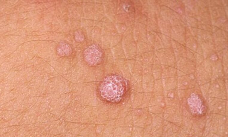 A HPV bőrpapillómák megjelenéséhez vezet