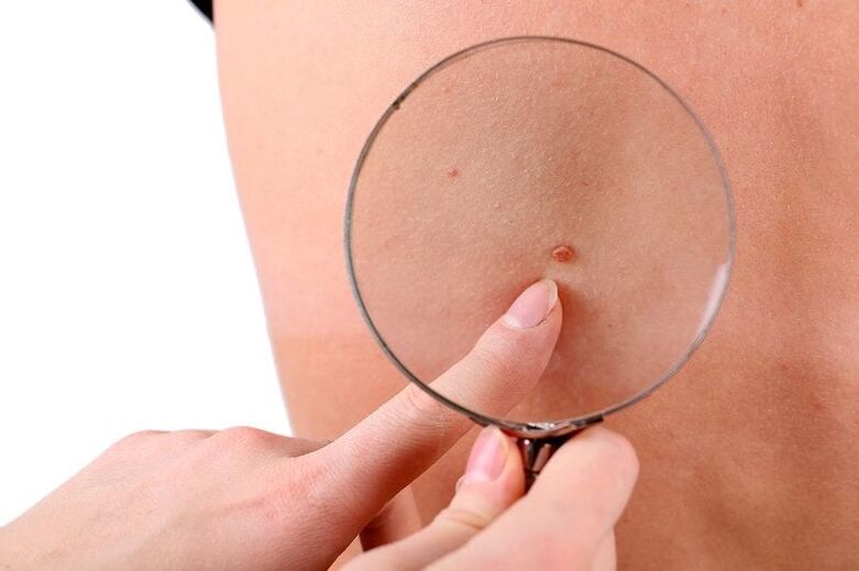 Papilloma nagyító alatt