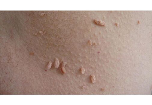 A HPV fertőzés jele a papillómák megjelenése a testen