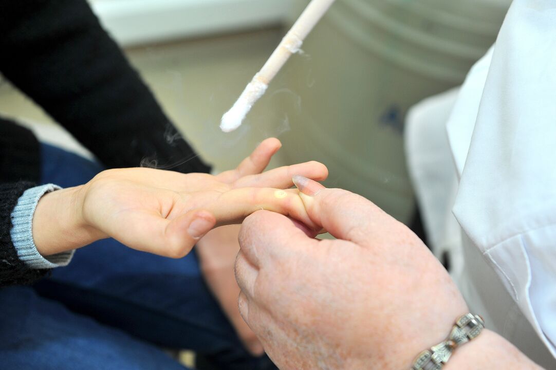 gyógyulási időszak a szemölcs eltávolítása után