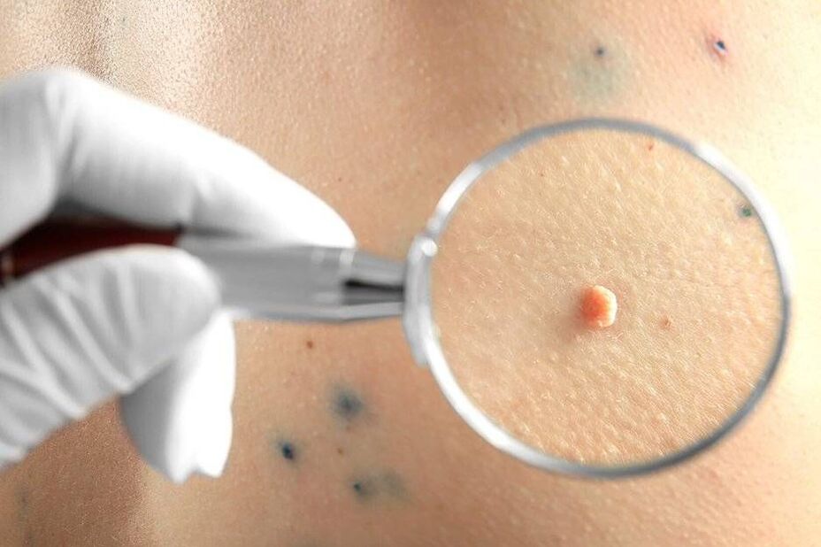 HPV kezelés