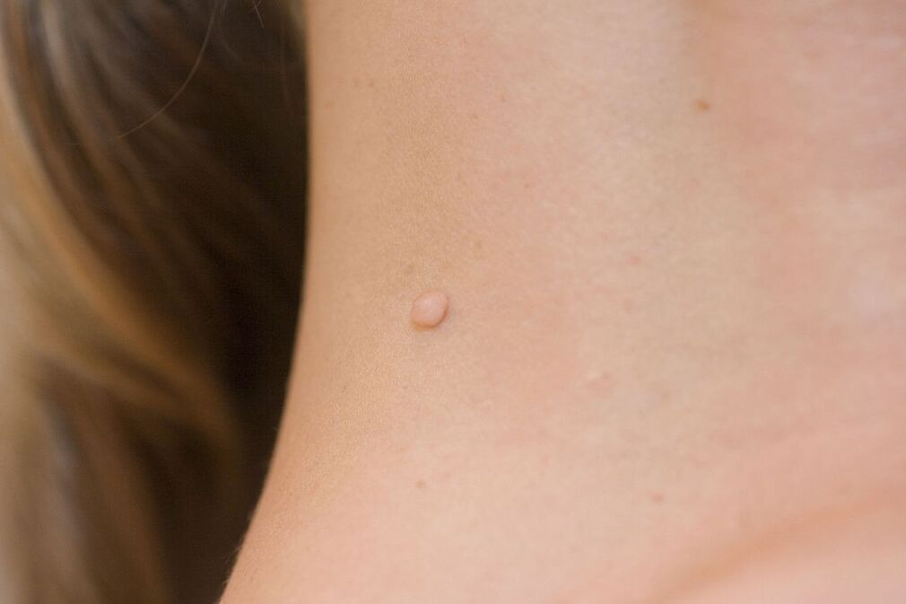 HPV tünetek